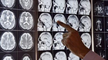 Ibogaine offers breakthrough treatment for mental health, addiction, and TBIs